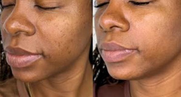 Chemical Peel (Level 2)