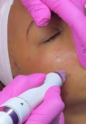 Hydro dermabrasion Facial