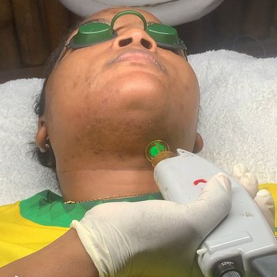 Laser Hair Reduction 