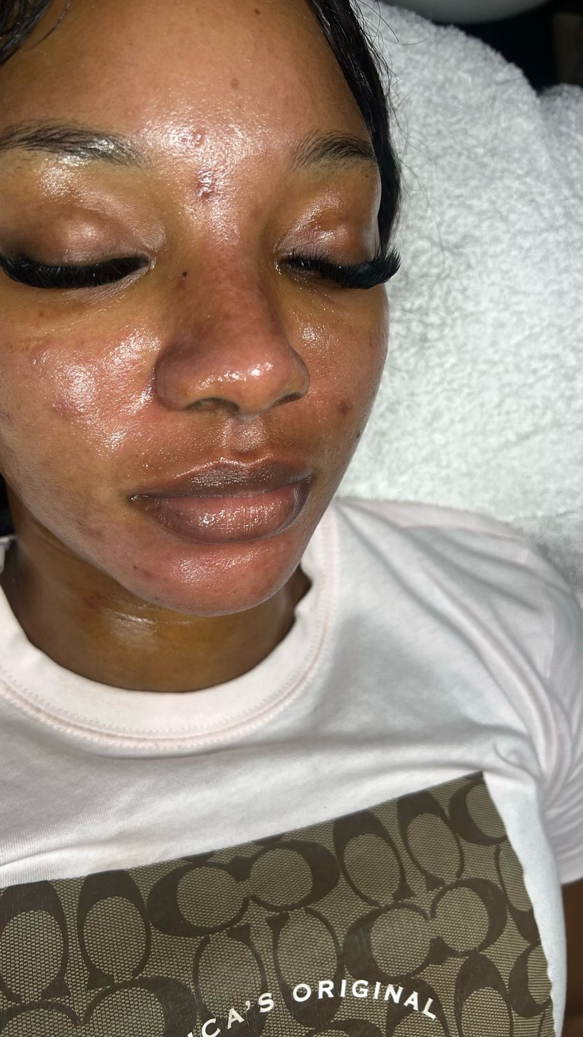 Chemical Peel (Level 3)