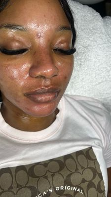 Chemical Peel (Level 3)