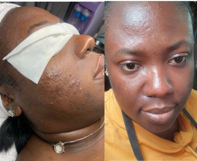Chemical Peel (Level 3)