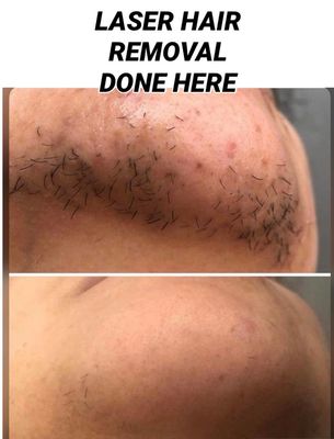 Chin &amp; Lip Laser Reduction