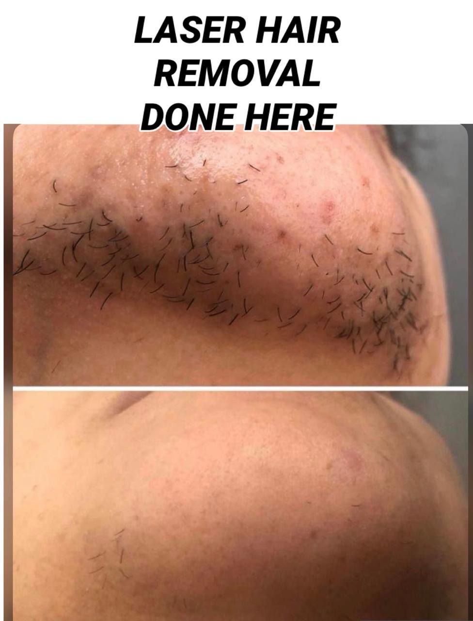 Chin &amp; Lip Laser Reduction