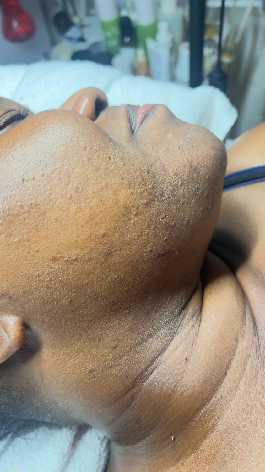 Microdermabrasion facial