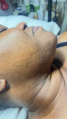 Microdermabrasion facial