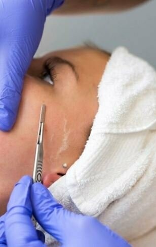 Dermaplaining
