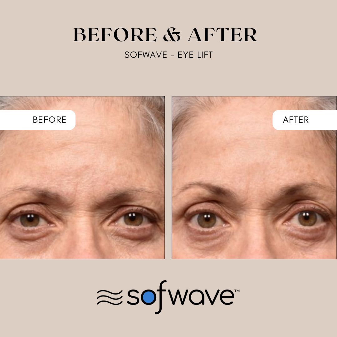 XMAS IN JULY: Sofwave Brow/Eye Lift - Limited quantity