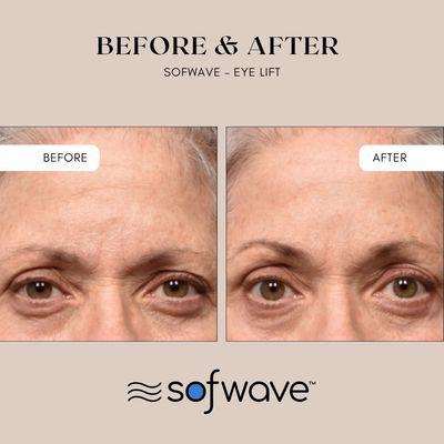 XMAS IN JULY: Sofwave Brow/Eye Lift - Limited quantity