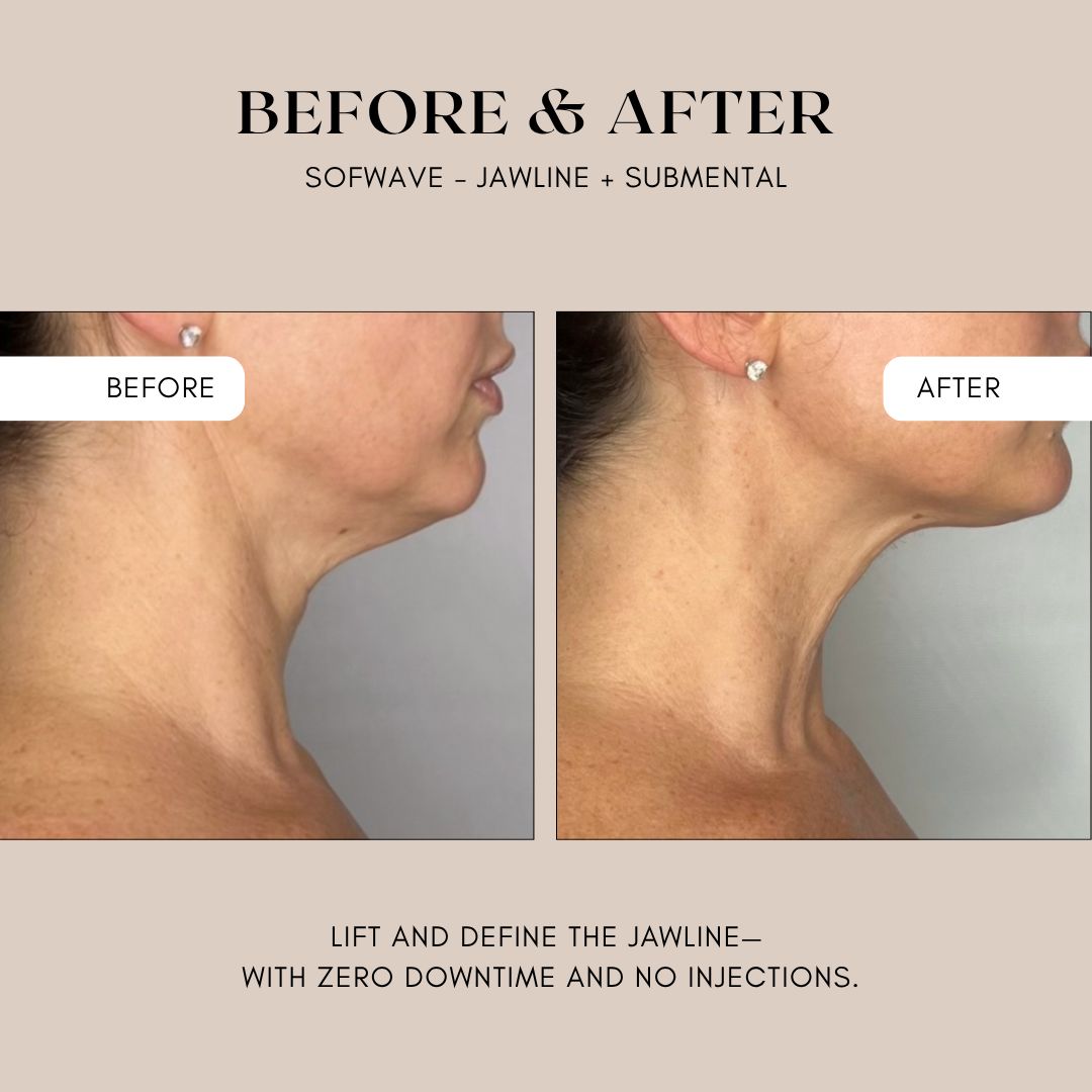 XMAS IN JULY: Goodbye jowls, hello Jawline (2 Options) - Limited quantity