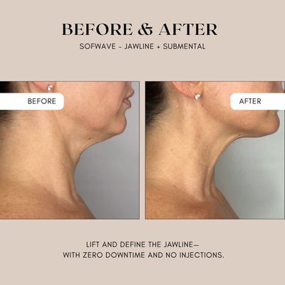 XMAS IN JULY: Goodbye jowls, hello Jawline (2 Options) - Limited quantity