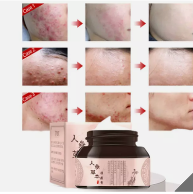 EFICAZ Crema Para El Acne ELIMINA Barros Espinillas Manchas RECUPERA Piel Limpia