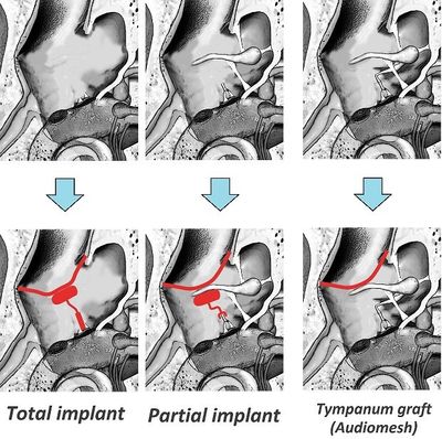Prosthesis for tympanoplasty