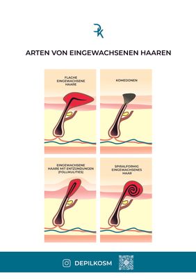 Poster für Kosmetik Studio &quot;Arten von eingewachsenen Haaren&quot;