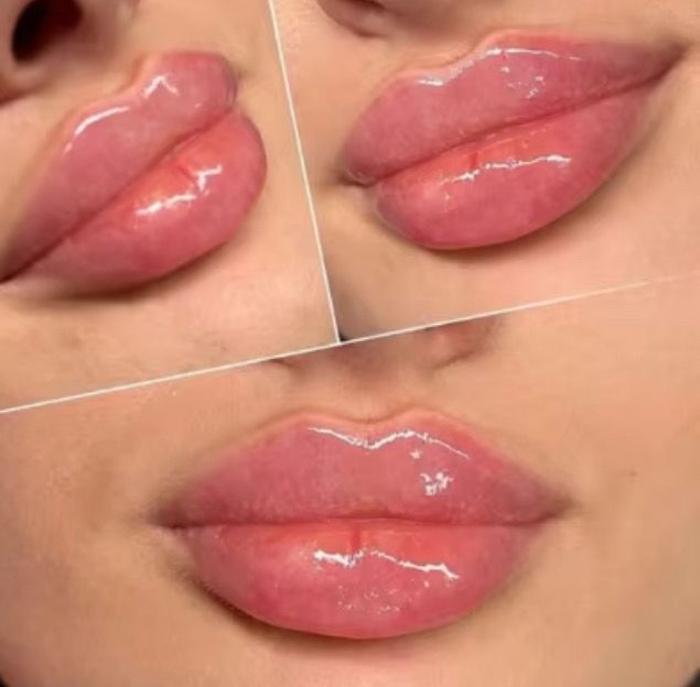 Plurvel Lips - Ha Filler 1ml