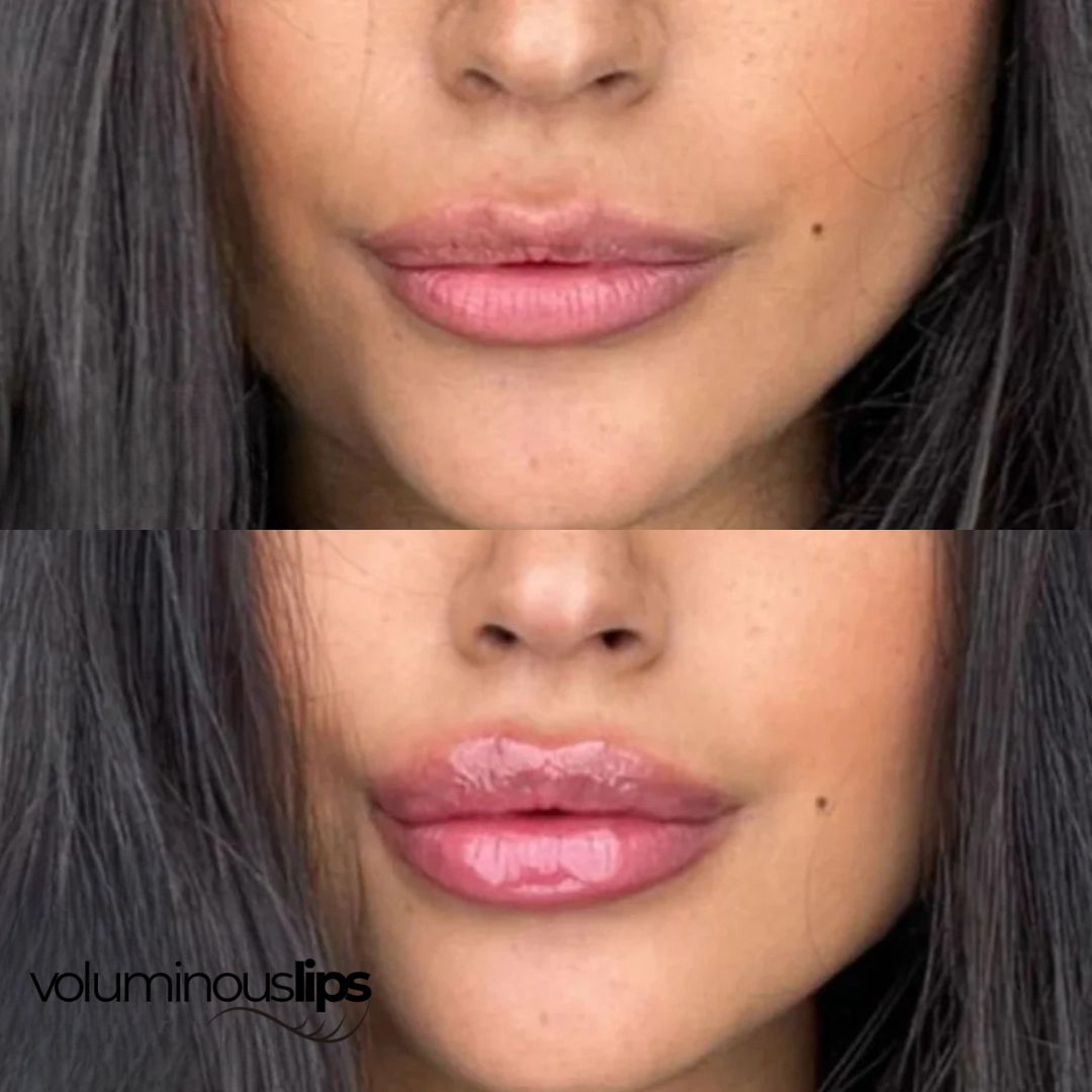 Voluminous Lips