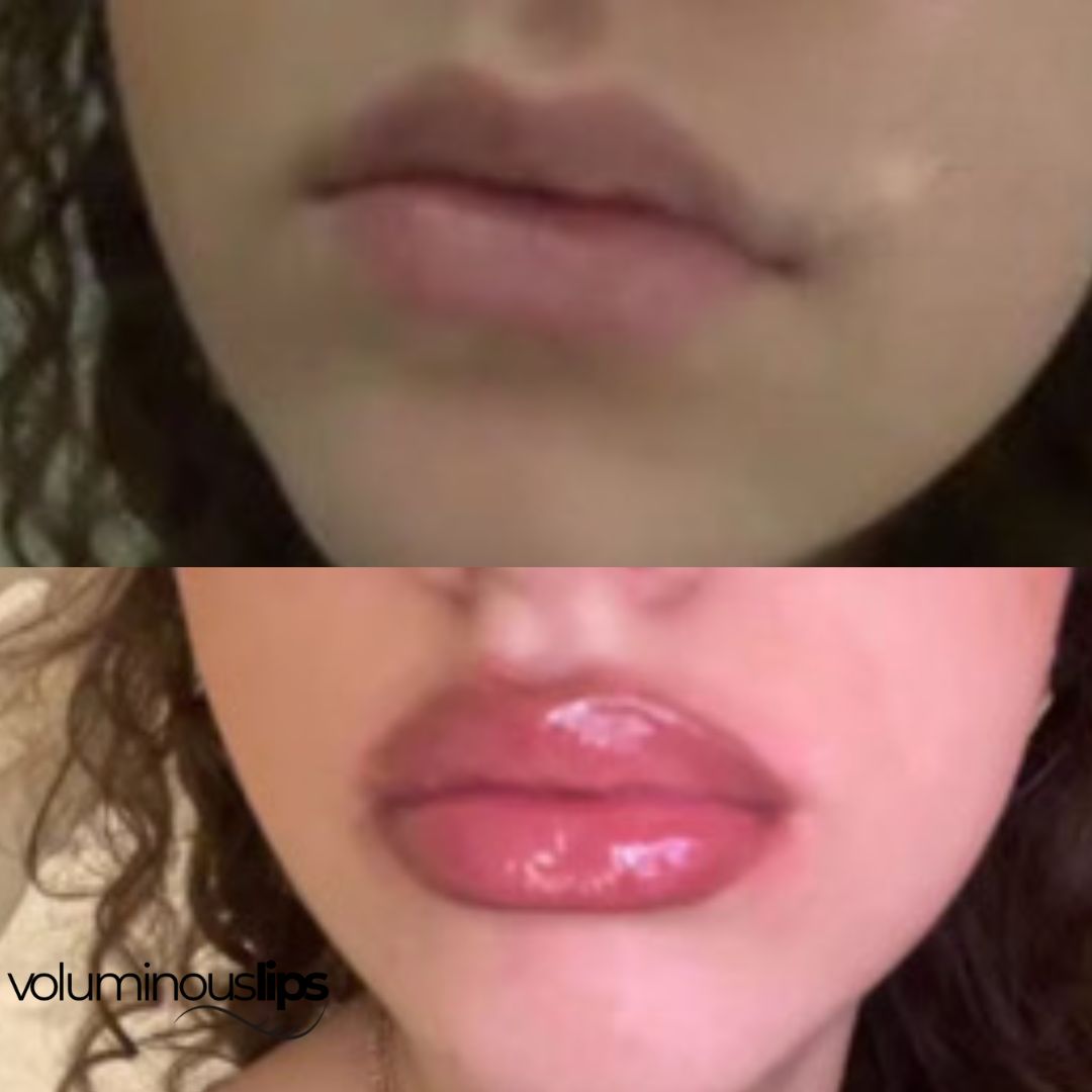 Voluminous Lips