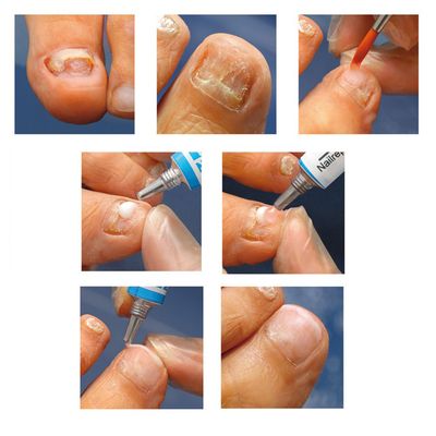 GEHWOL Podo Nail Repair Gel M pink 5ml