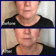 CRYOTHERAPY FACIAL