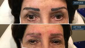 PMU TATTOO REMOVAL PMU TATTOO REMOVAL