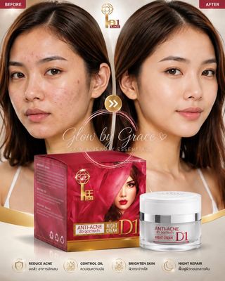 D1 ANTI ACNE CREAM +SOAP