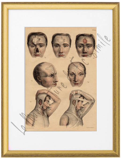 CHIRURGIE DU NEZ