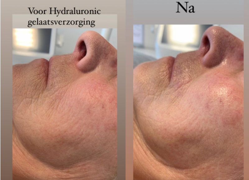 Hydraluron gelaatsverzorging met hyaluronzuur & gepatenteerd HLG