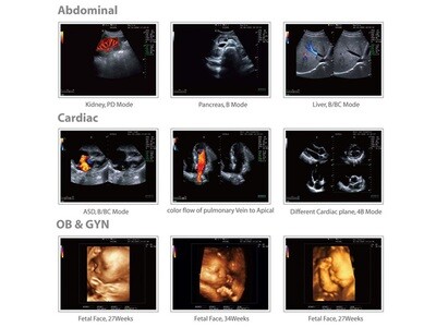 CHISON Q9 PORTABLE COLOURDOPPLER + 4D PROBE AND SOFTWARE