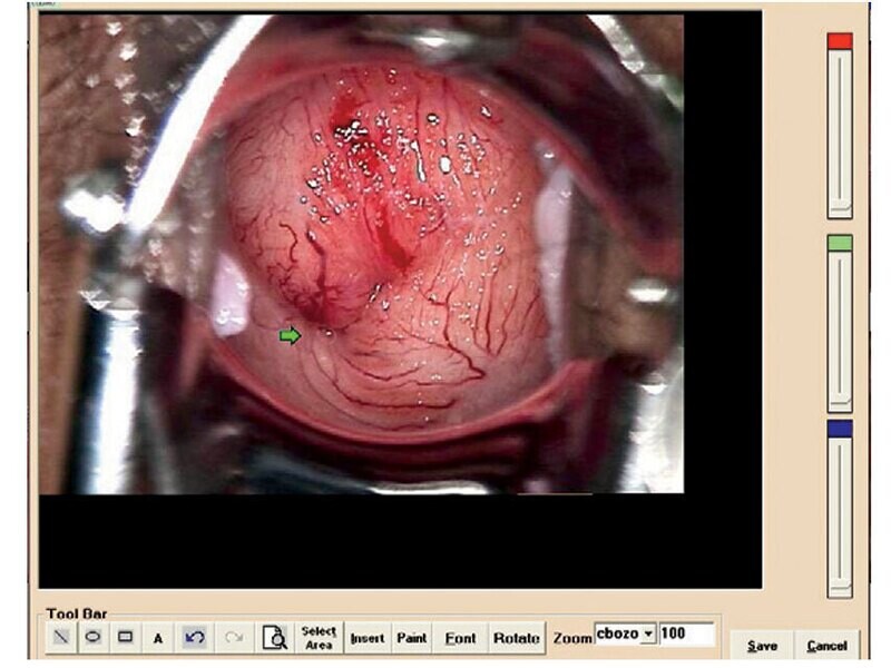 COLPOSCOPY SOFTWARE for 29620, 29600 with 29603