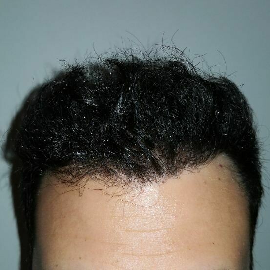Autotrapianto Capelli