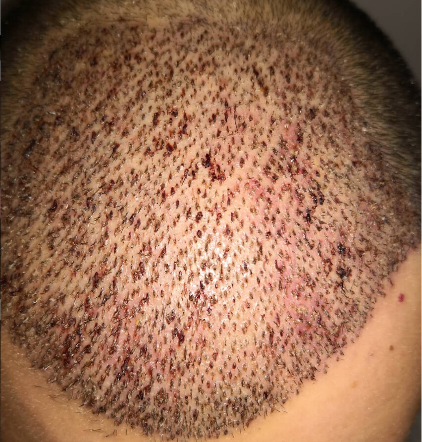 Autotrapianto Capelli