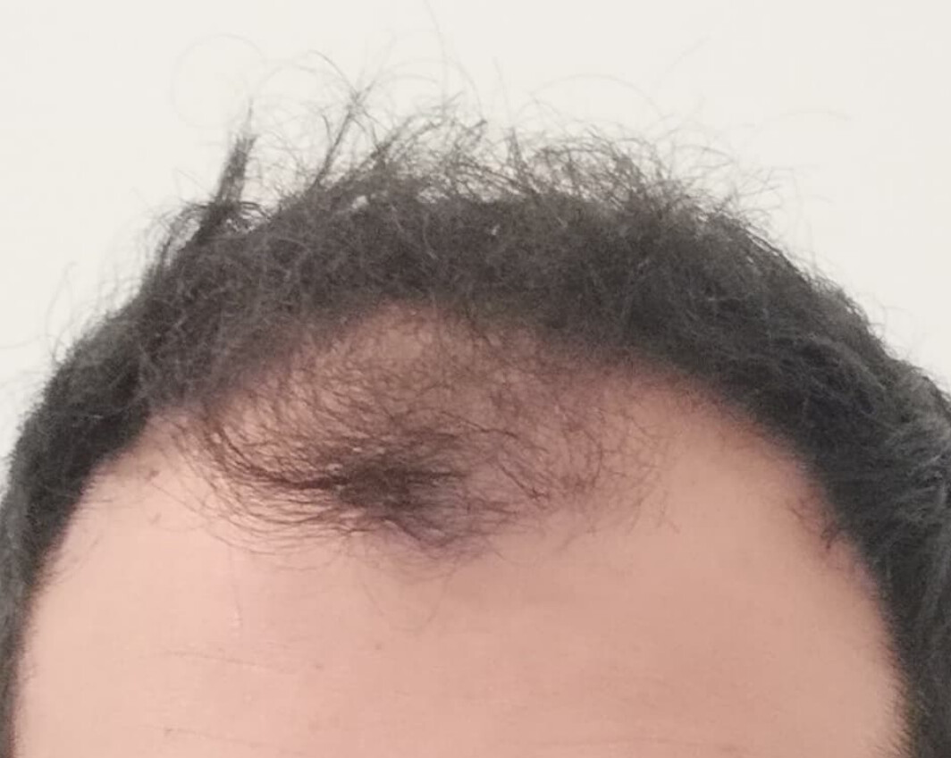 Autotrapianto Capelli