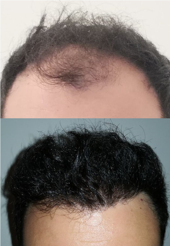 Autotrapianto Capelli