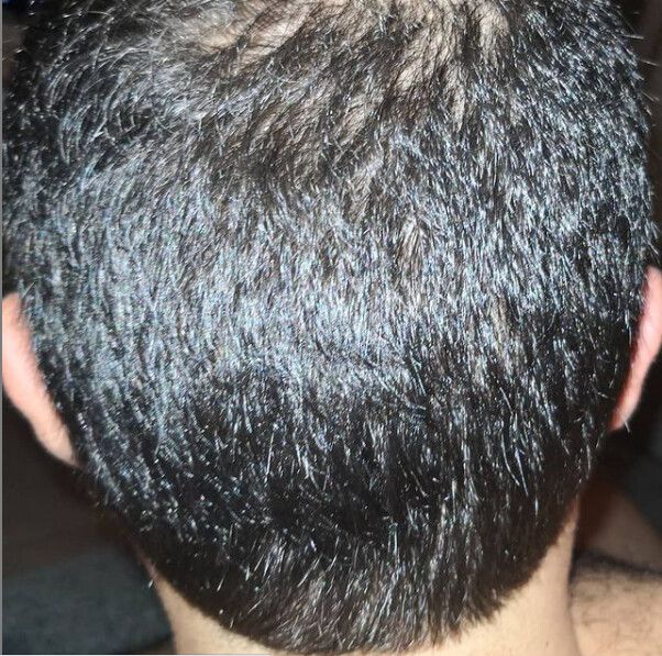 Autotrapianto Capelli