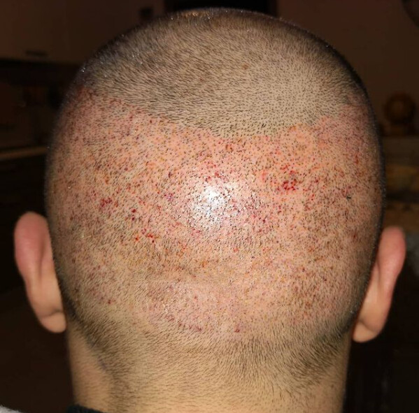 Autotrapianto Capelli