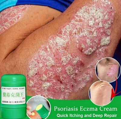 Crema Para La Psoriasis
