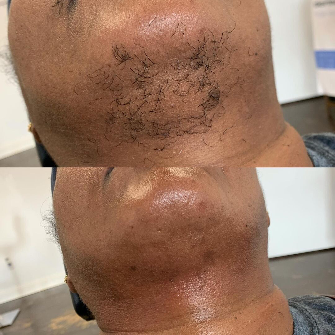 Chin Waxing