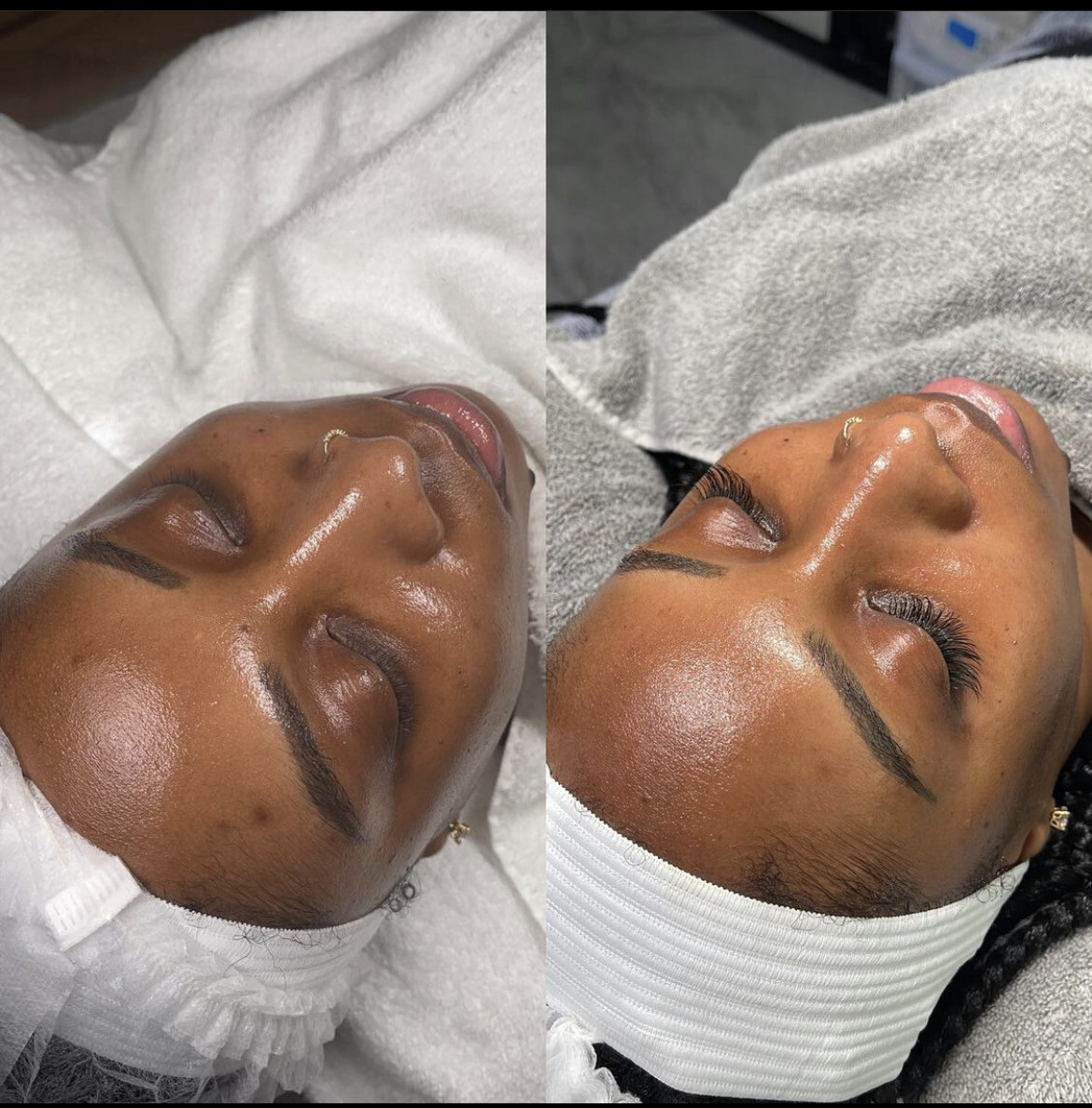 Hydro Luminescence Facial: Experience the Glow of Hydration