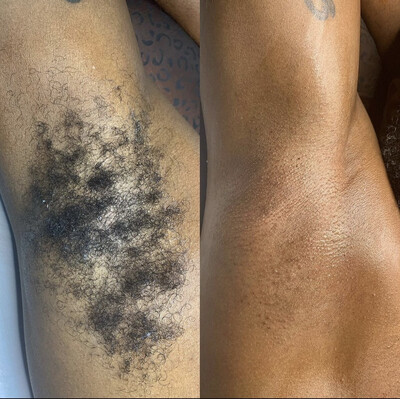 Underarm Wax ( Male )