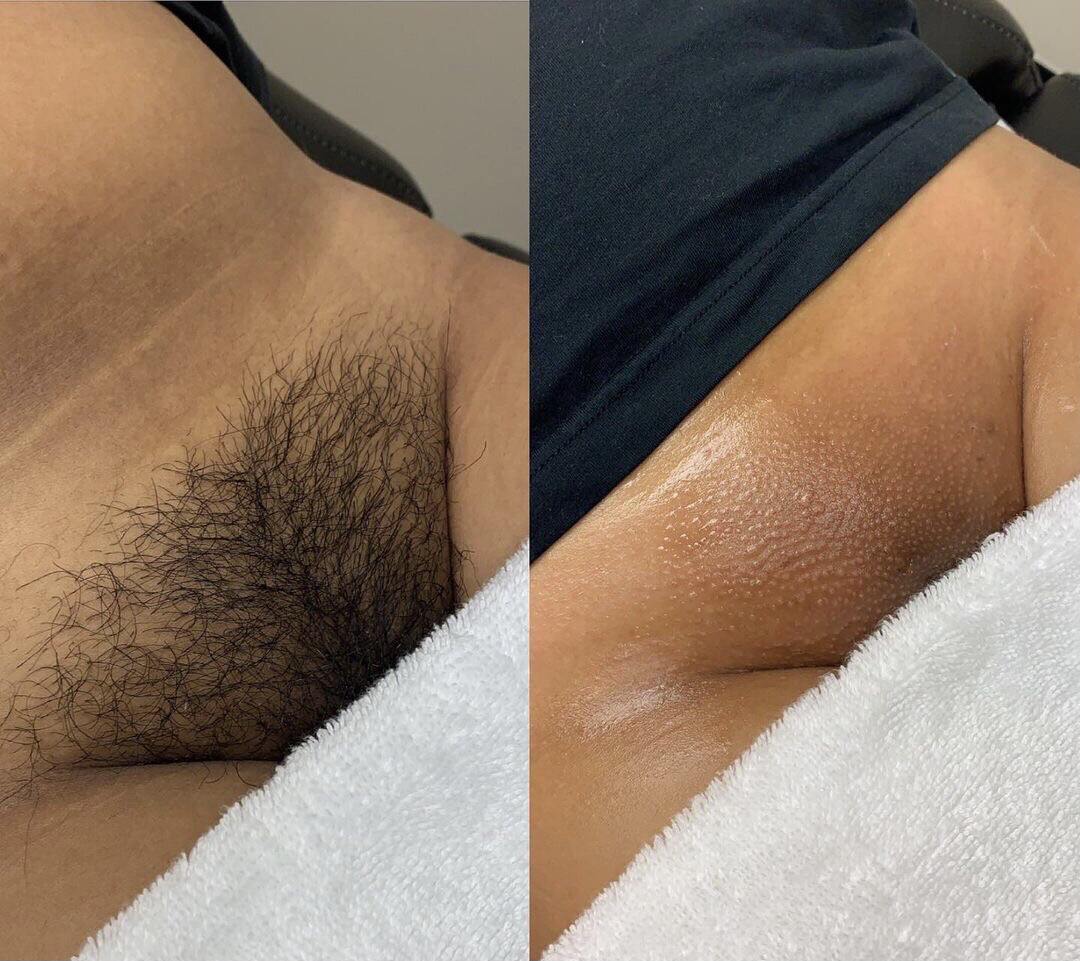 Brazilian Wax