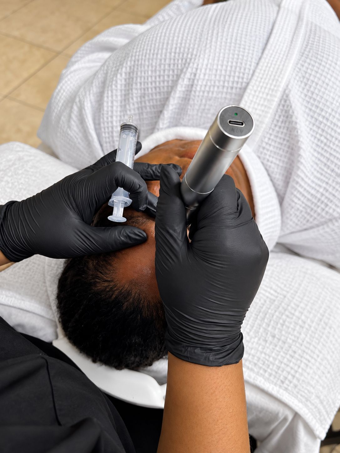 Tier 4 : Advanced Microneedling Treatment