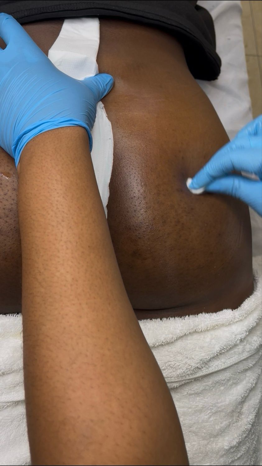 Butt Chemical Peel