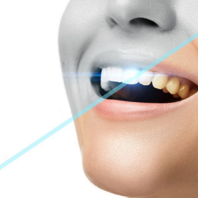 Teeth Whitening