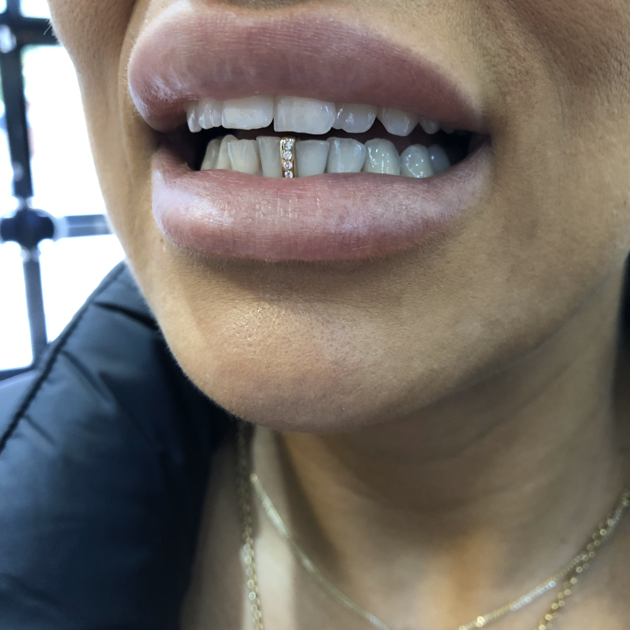 Gap Filler Single Gold Teeth with VVS Diamonds - Gold Grillz