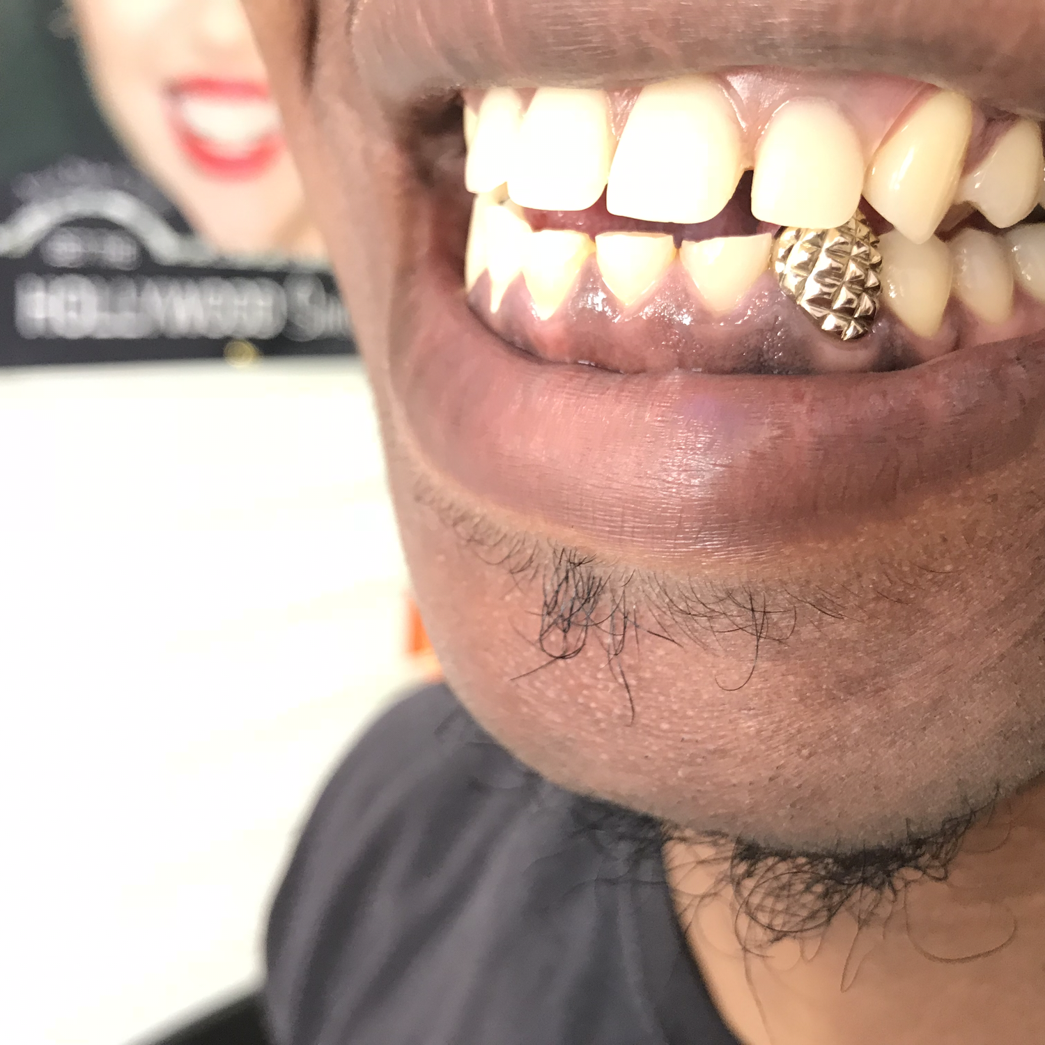 Gold Teeth - Pineapple Design - Custom Gold Teeth Grillz