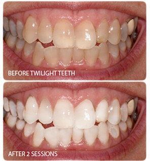 Twilight Teeth Whitener Kit