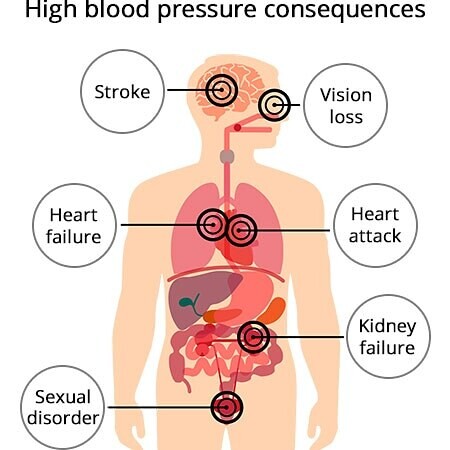 Natural remedy for High Blood Pressure (HYPERTENSION) | Natural BP remedy