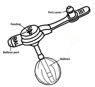 Mic-Key Gastrostomy Feeding Tube 20 FR — 3.0cm