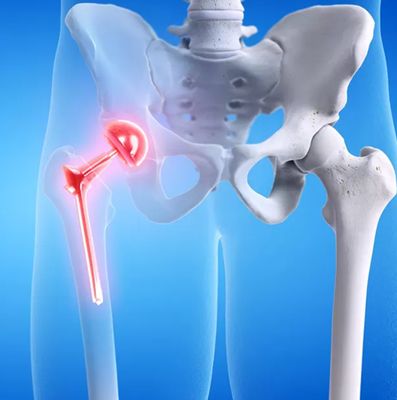 Hip Surgery Recommendations