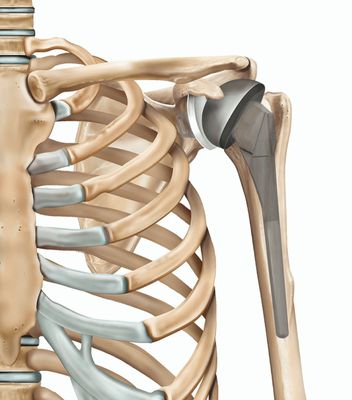 Shoulder Surgery Recommendations